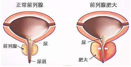 正常前列腺大小